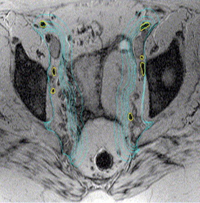 Development of 3-D techniques Significant proportion have suboptimal nodal coverage Techniques to evaluate nodes MRI with contrast