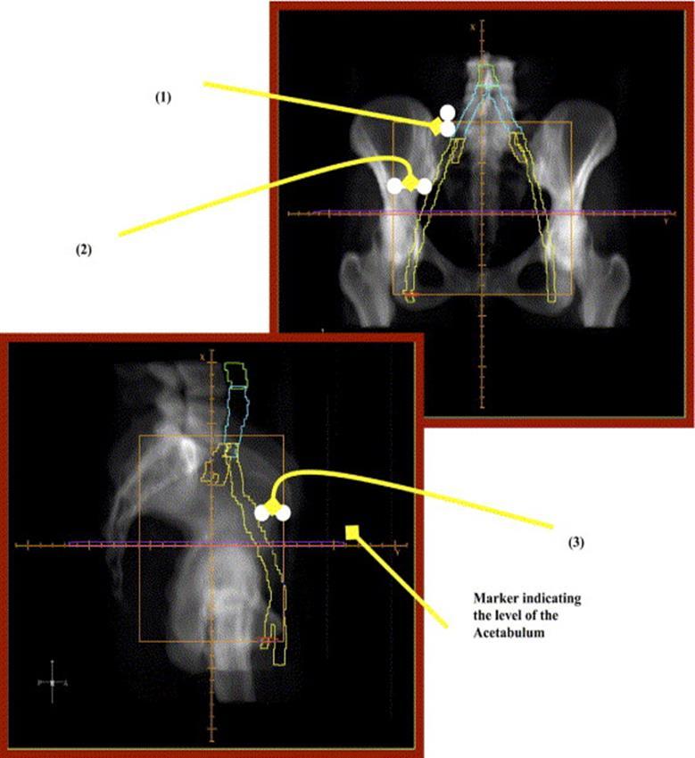 Moving from 2-D to 3-D Risk of geographical miss of both primary and nodal areas Unnecessary irradiation of normal tissues: bladder, rectum, small bowel and bone