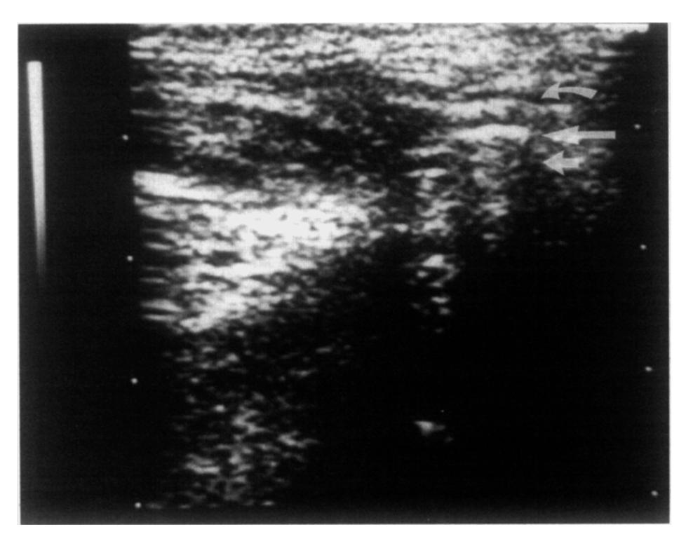value of ultrasonography as a diagnostic aid in patients with TMDs. MATERIAL AND METHODS This study included 17 patients presenting with signs and symptoms of TMD.