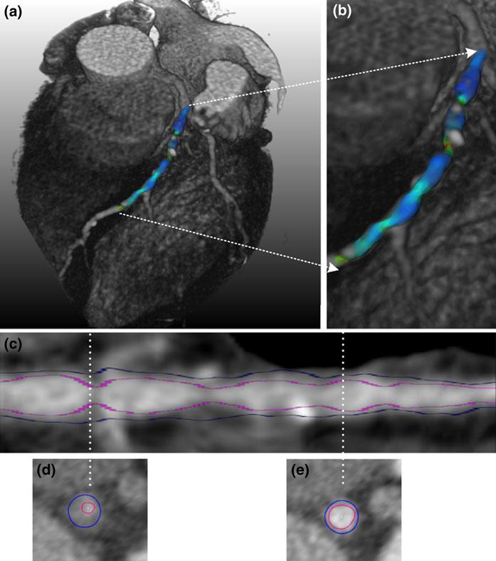 788 Int J Cardiovasc Imaging (21) 26:781 796 Fig. 4 IVUS fused in CT. a 3D CT dataset of the heart fused with the IVUS derived geometry of the lumen on which the calculated values are depicted.