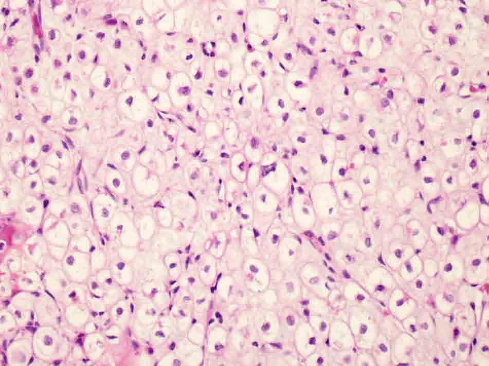Bone, left femoral neck, curettage: H & E stain, 20x Presentation material is