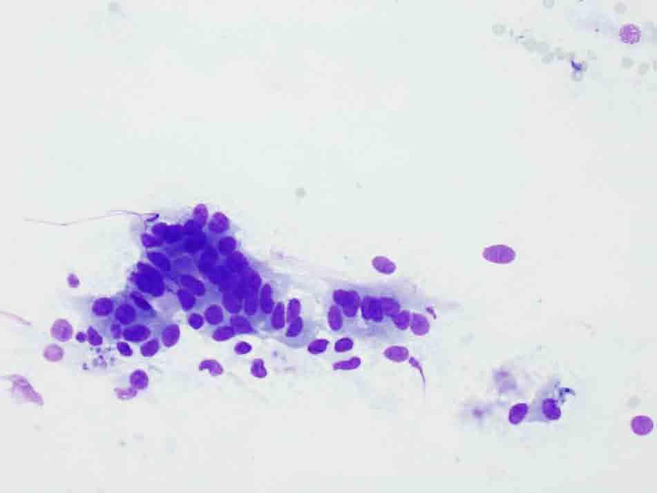 Liver, ultrasound-guided FNA: Diff-Quik stain, 20x Presentation material is for