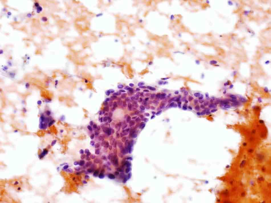 Liver, ultrasound-guided FNA: Papanicolaou stain, 20x Presentation material is