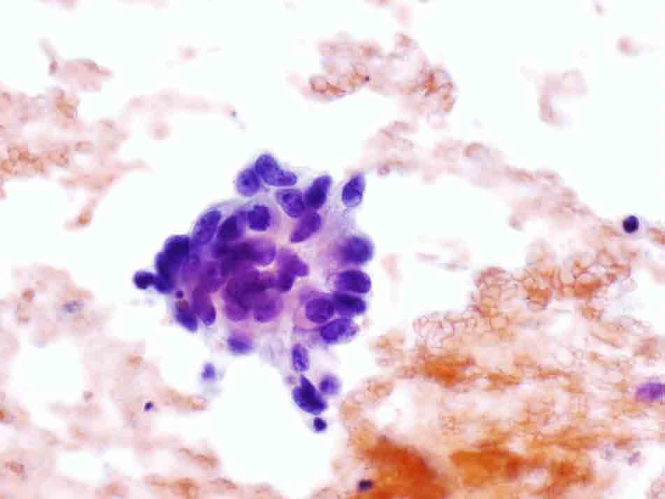 Liver, ultrasound-guided FNA: Papanicolaou stain, 40x Presentation material is