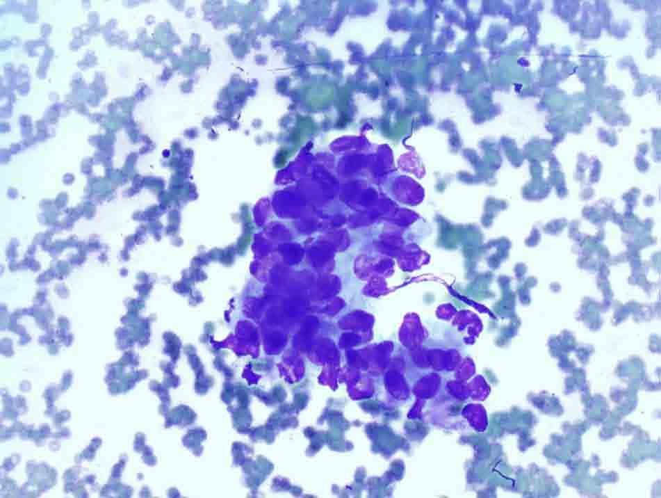 Lymph node, retroperitoneal, left, CTguided FNA: Diff-Quik stain, 20x Presentation