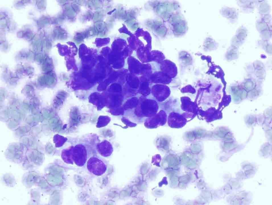 Lymph node, retroperitoneal, left, CTguided FNA: Diff-Quik stain, 40x Presentation