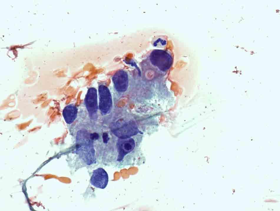 Lymph node, retroperitoneal, left, CT-guided FNA: Papanicolaou stain, 40x Presentation