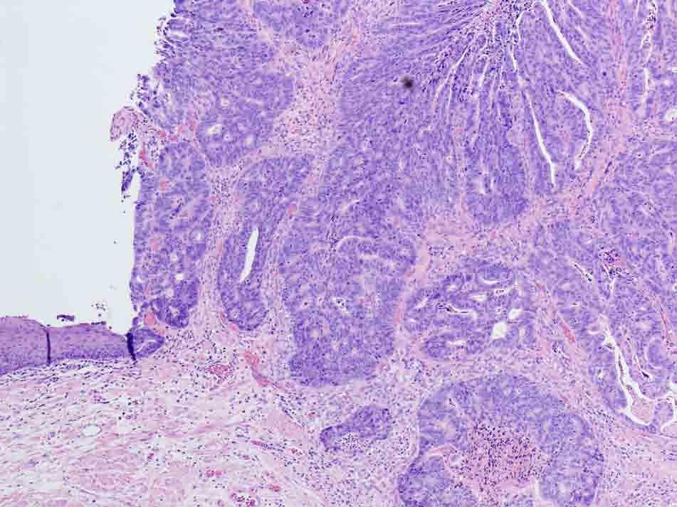 Distal esophagus and proximal stomach: H & E stain, 4x Presentation material is