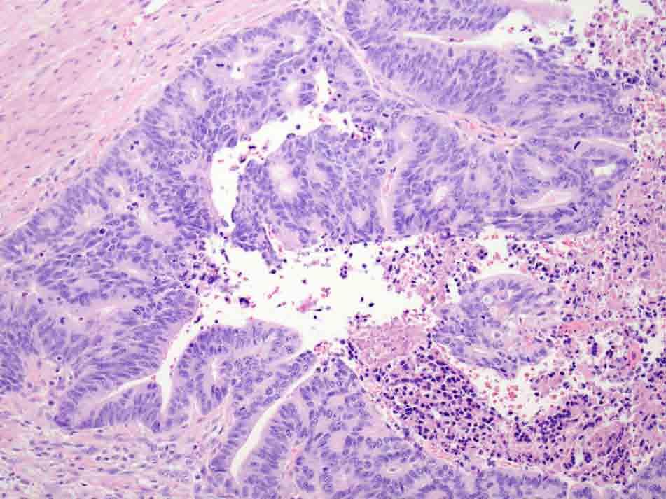 Distal esophagus and proximal stomach: H & E stain, 10x Presentation material is