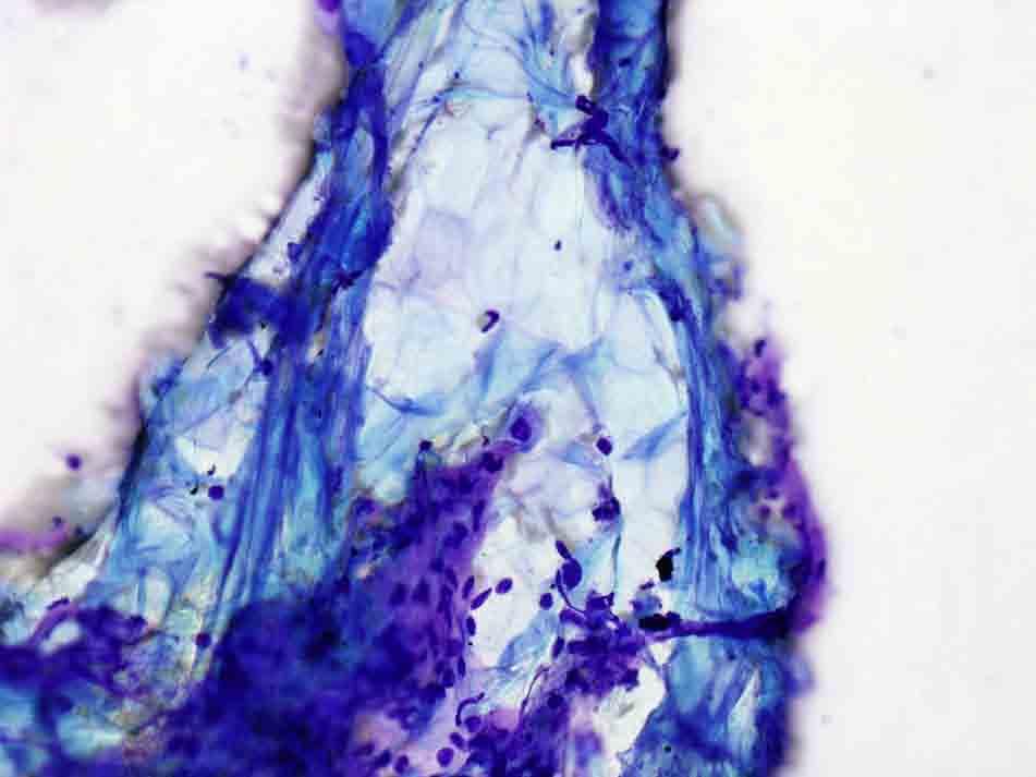 Lung, right lower lobe, CTguided FNA: Diff-Quik stain, 20x Presentation material is