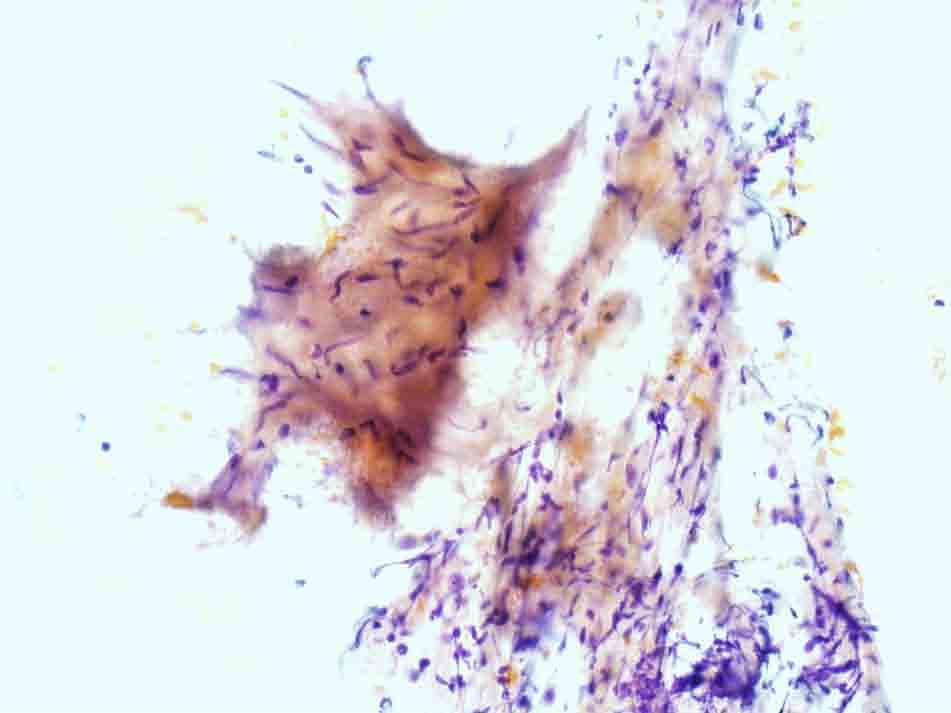Lung, right lower lobe, CTguided FNA: Papanicolaou stain, 20x Presentation material