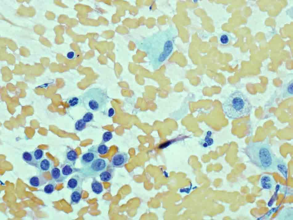 Lung, right lower lobe, CTguided FNA: Papanicolaou stain, 40x Presentation material