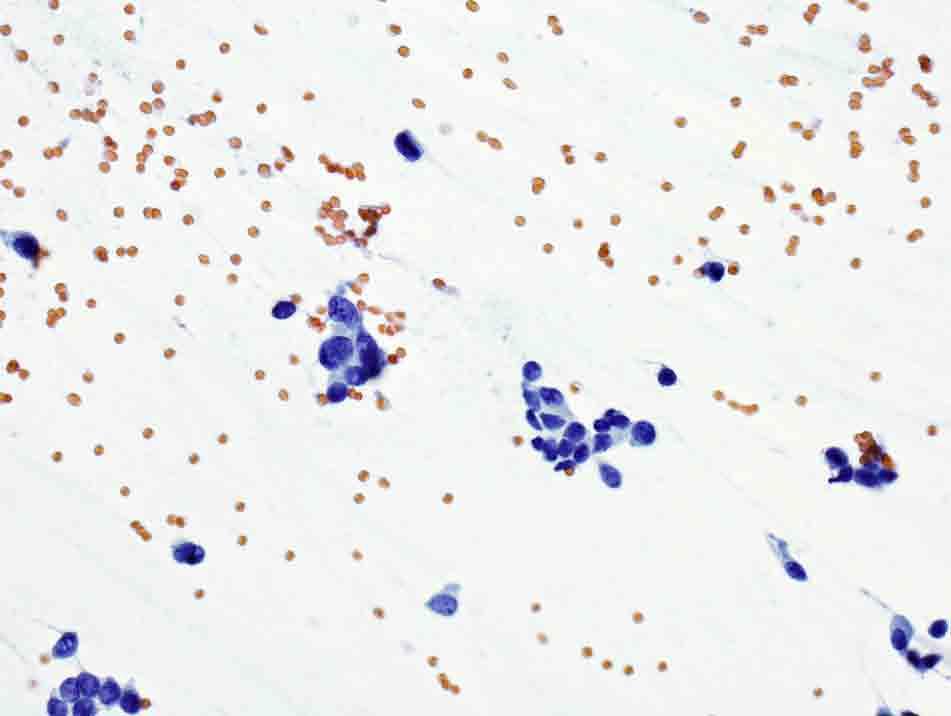 Bone, iliac wing, CT-guided FNA: Papanicolaou stain, 40x Presentation material is