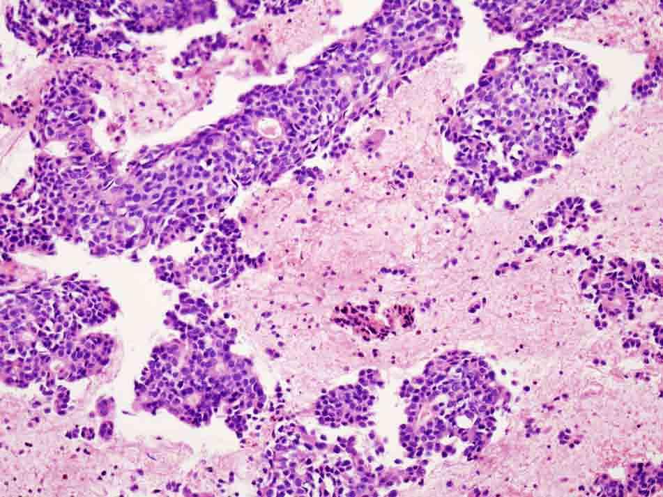 Bone, iliac wing, CT-guided FNA: Cell block, H & E stain, 10x Presentation material