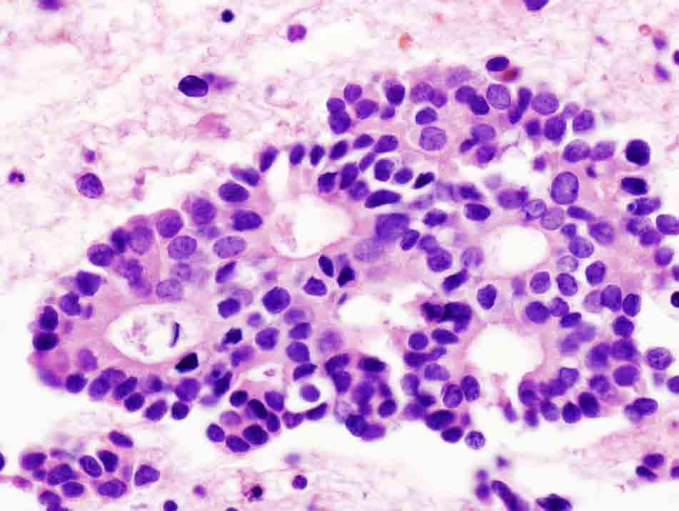Bone, iliac wing, CT-guided FNA: Cell block, H & E stain, 40x Presentation material