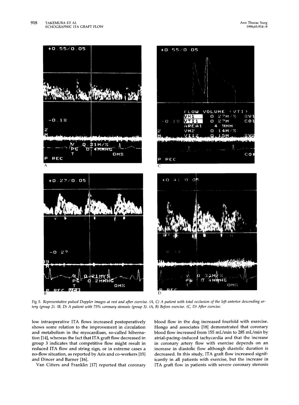 918 TAKEMURA ET AL Ann Thorac Surg ECHOGRAPHC TA GRAFT FLOW 1996;61:914-9 -O.1H A C B D Fig 5. Representative pulsed Doppler images at rest and after exercise.