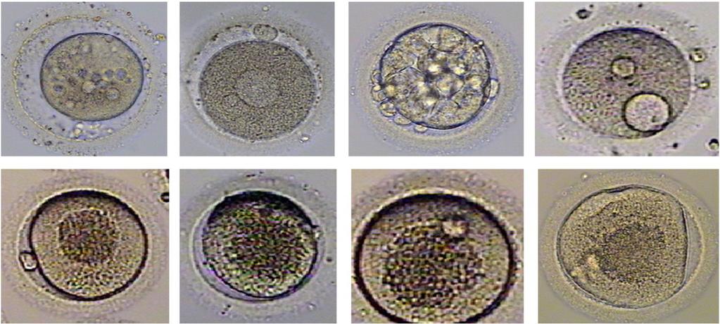 Intracytoplasmic Sperm Injection Factors Affecting Fertilization 133 rate [161].