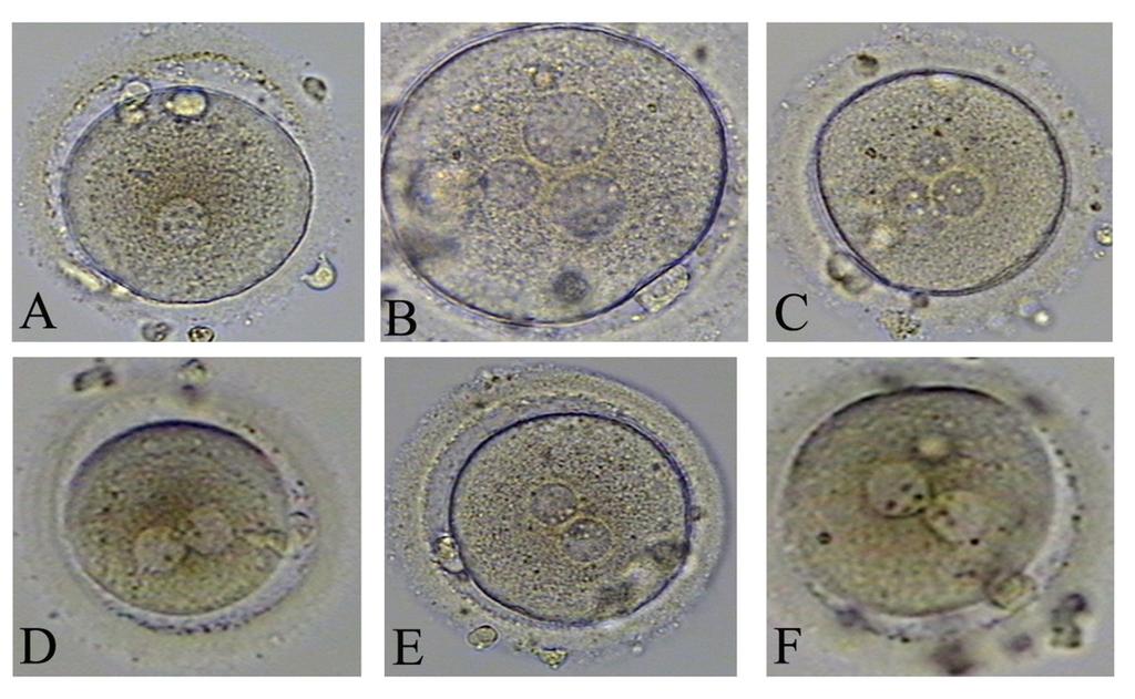 Intracytoplasmic Sperm Injection Factors Affecting Fertilization 119 Figure 2. First row: A is an egg with1 pronucleus (PN), B with 3 and C with 4 PN. All these are abnormal fertilizations.