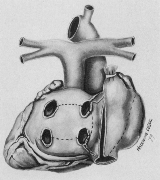 Ann Thorac Surg CONGENITAL HEART CHARTRAND 717 PEDIATRIC CARDIAC TRANSPLANTATION When the recipient pulmonary artery or branches need to be reconstructed and when the great vessels are in D- or