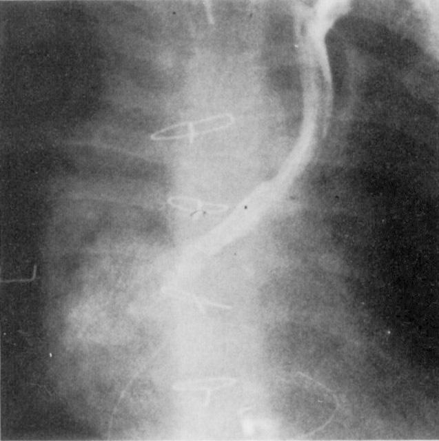 Heart Transplant 1990;9:608-17, by permission of MoSh- Year Book, lnc.) Fig 7. Postoperative alzgiograrn showing adequate superior reroofing.