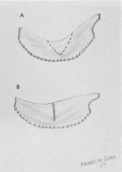 720 CONGENITAL HEART CHARTRAND PEDIATRIC CARDIAC TRANSPLANTATION Ann Thorac Surg Fig 9. Septnl realipnrnent. (A) V-shaped incisio~ is rmde in center of free edge of patch to allozc, straightening.