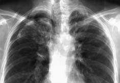 Mayo Clin Proc, May 2003, Vol 78 BCNU-Associated Pulmonary Fibrosis 631 Figure 1.