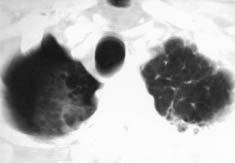 multiple small right apical subpleural bullae (middle), and a small right pleural effusion (bottom).