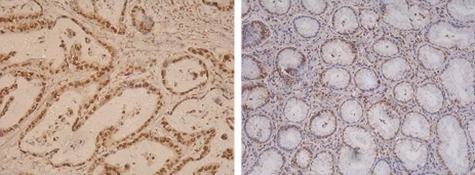 Clin Oncol Cancer Res (2009) 6: 208-213 211 A B Fig.1. Expressions of REGγ in gastric cancer (A) and in normal gastric tissue (B) ( 200). M 1 2 3 4 M 1 2 3 4 M 1 2 3 4 2000 1000 750 500 250 100 Fig.2. Denaturing gel electrophoresis of RNA.