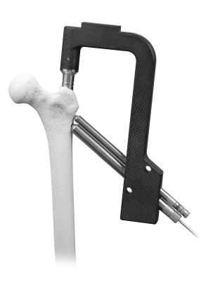 12 ITST Intramedullary Nail Surgical Technique Lag Screw Preparation Note: The 6.5mm Anti-Rotation Screw may be used to enhance fracture stability if the femoral neck is able to accommodate it.