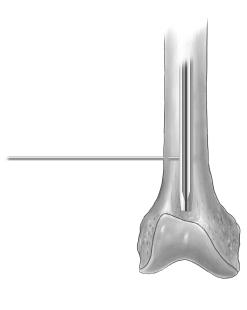ITST Intramedullary Nail Surgical Technique 21 Remove the Drill and insert the Distal Screw Depth Gauge (Fig. 61).