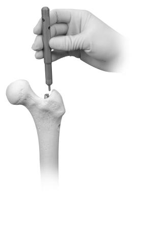 24 ITST Intramedullary Nail Surgical Technique Closure and Postoperative Care Close the proximal wound and apply a soft compression dressing.