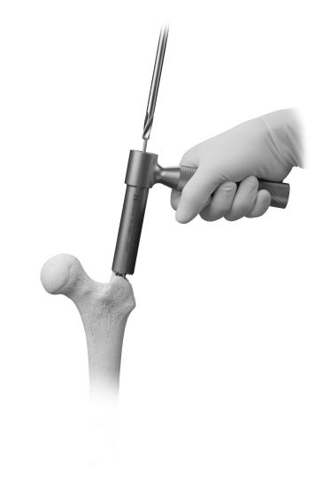 4 ITST Intramedullary Nail Surgical Technique Creating the Entry Portal Place the cannulated awl at the selected starting point (Fig.