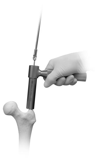 6 ITST Intramedullary Nail Surgical Technique Measure Determine the proper nail length by placing a second guide wire of equal length at the greater trochanter.