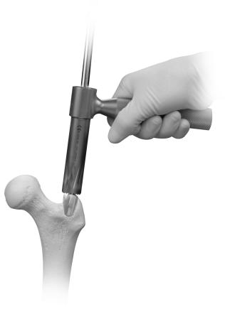 ITST Intramedullary Nail Surgical Technique 7 Over-reaming the canal by one or two millimeters may facilitate preparation of the bone to accommodate the implant.