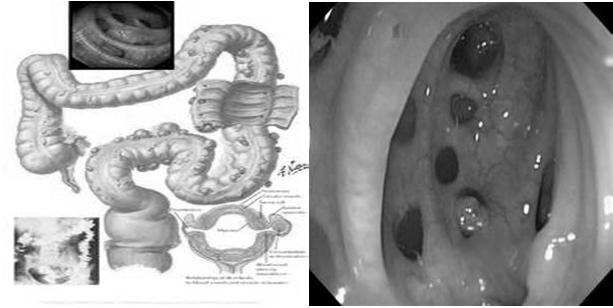 DEFINITIONS-CONTINUED Diverticulitis-macroscopic inflammation of diverticula resulting in acute or chronic complications Acute uncomplicated-colonic wall thickening with fat stranding