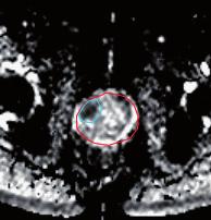 contrast-enhanced MRI (C), with dose distribution shown in (D). Imaging and dose parameters for the gross target volume and remainder of the prostate are shown in Table 1. (MRSI).