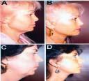 Different levels of undermining in face lift Figure 2: A: preoperative; face and neck ptosis with abnormal submental angle.
