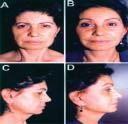 Figure 4: A: preoperative; face and neck ptosis with moderate platysmal bands. B: 18 months after face and neck lifting with platysmal band treatment and blepharoplasty.