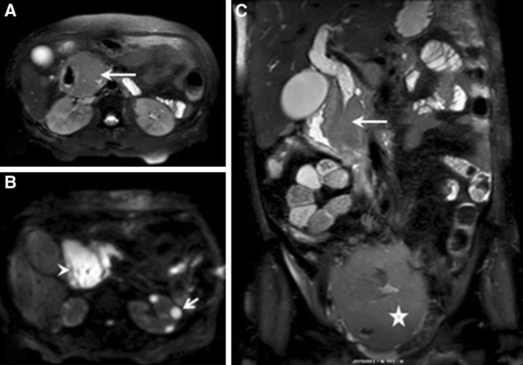 72 Page 12 of 13 Curr Radiol Rep (2014) 2:72 Fig. 16 a, b, and c T2 weighted fat-suppressed images in axial and coronal planes of the same patient in Fig.