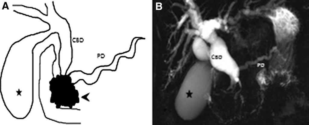 DWI images showing foci of diffusion restriction of the pancreatic mass (arrowhead) with renal deposits (small arrow) representing a lymphoproliferative disorder.