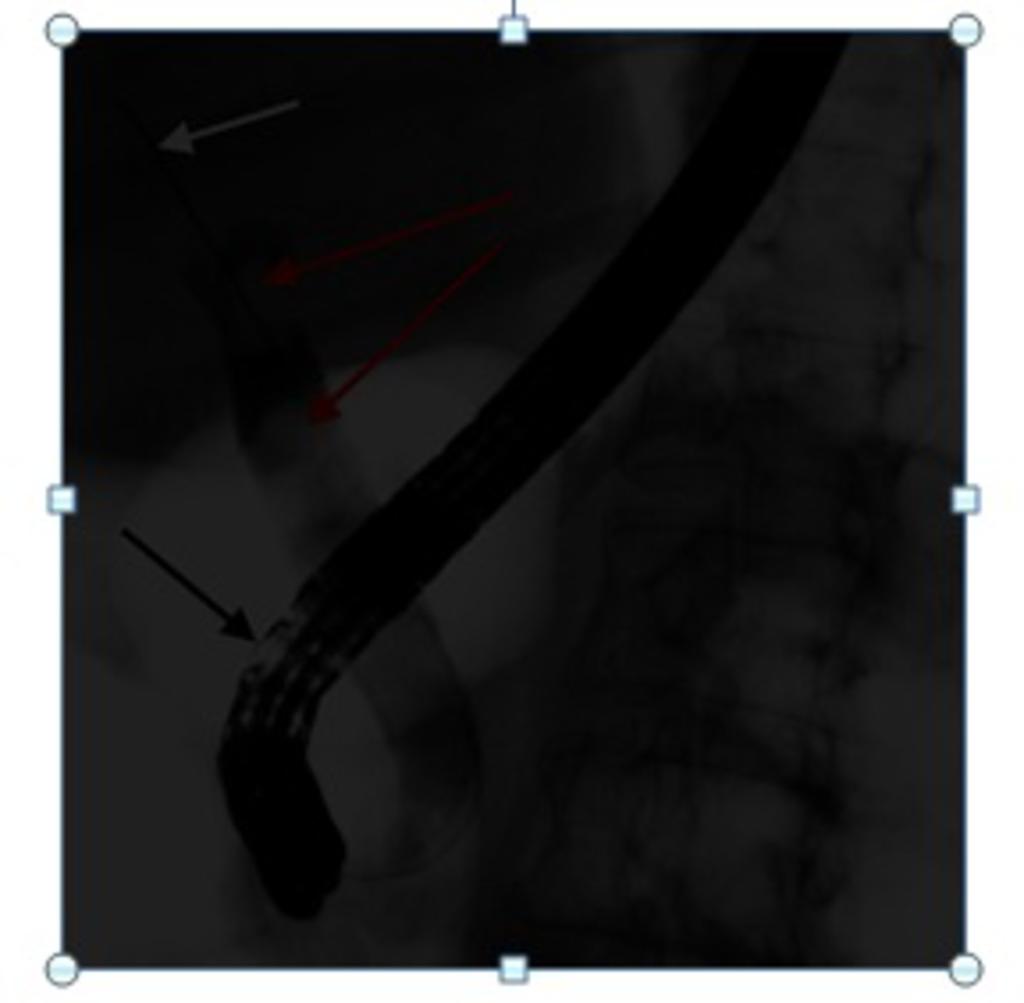 Fig. 5: ERCP for stent insertion, demonstrating impacted obstructing gallstones (red