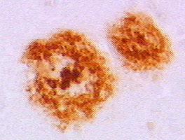 β-amyloid Plaques Immunocytochemical staining of senile plaques in
