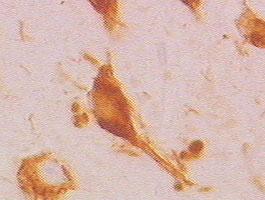 Neurofibrillary Tangles Immunocytochemical staining of neurofibrillary