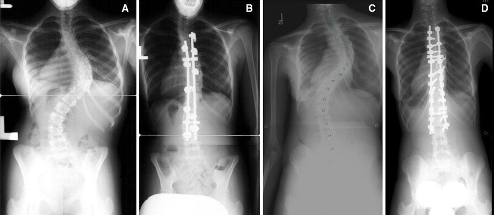 J Child Orthop (2012) 6:137 143 139 Fig. 1 Preoperative and postoperative radiographs of curves treated with a hook construct (a, b) and with a pedicle screw construct (c, d).