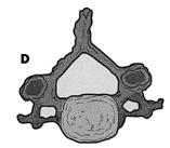 vertebral arch - fuses ventrally with the centrum Sclerotome