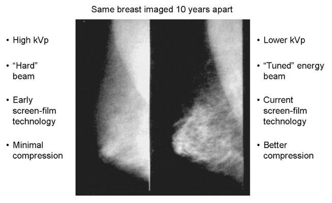 Mammography Evolution Complementary Imaging Technology Ultrasound Cyst /