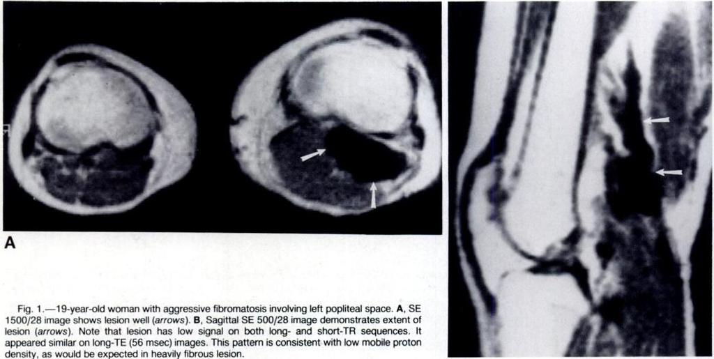 750 AISEN ET AL. AJR:146, April 1986 to surrounding nerves and/or blood vessels [20 cases]; and (4) ability to assess extent of abnormality in the bone marrow [1 3 cases].