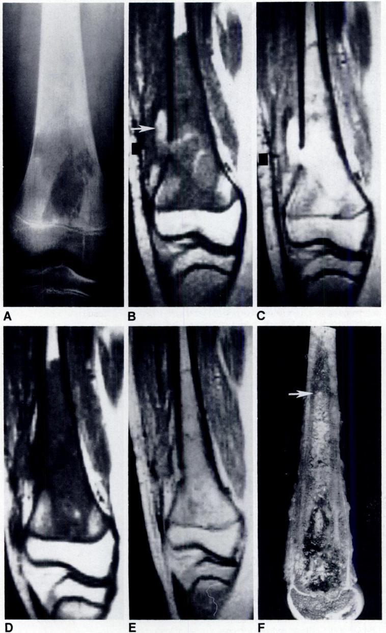 AJR:146, April 1986 MRI/CT OF BONE & SOFT-TISSUE TUMORS 751 Fig. 2-14-year-old boy with osteosarcomaofdistal rightfemur. A, Plain film. B, Coronal SE 500/28 image through losion.