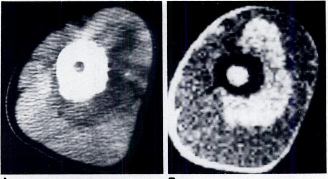 AJR:146, April 1986 MRI/CT OF BONE & SOFT-TISSUE TUMORS 753 Fig. 4.-i 3-year-old girl with osteosarcoma of proximal right tibia. Coronal SE 2000/28 image.