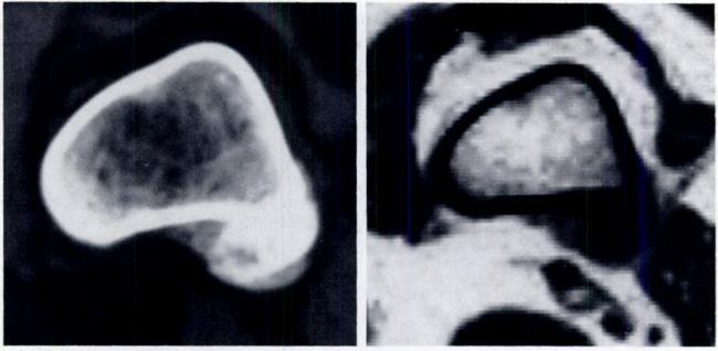 AJR:146, April 1986 MRI/CT OF BONE & SOFT-TISSUE TUMORS 755 Fig. 7-22-year-old woman with parosteal osteosarcoma of distal left femur.